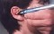 Auriculoterapia