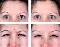 Aplicaci&oacute;n de botox