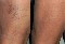 Tratamiento varices y vasitos