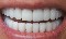 Limpieza dental gratis