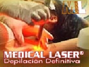 Depilacin laser definitiva