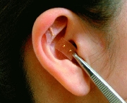 Curso a distancia de acupuntura de la oreja