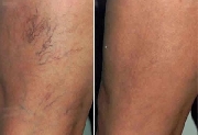 Tratamiento varices y vasitos