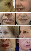 Plasmarico plaquetas rejuvenecimiento facial