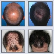 Regeneracion capilar y del cuero cabelludo