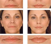 Corrección facial sin cirugia