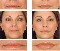 Corrección facial sin cirugia