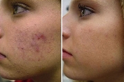 Eliminación definitiva del acné