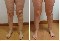 Elimine definitivamente la celulitis